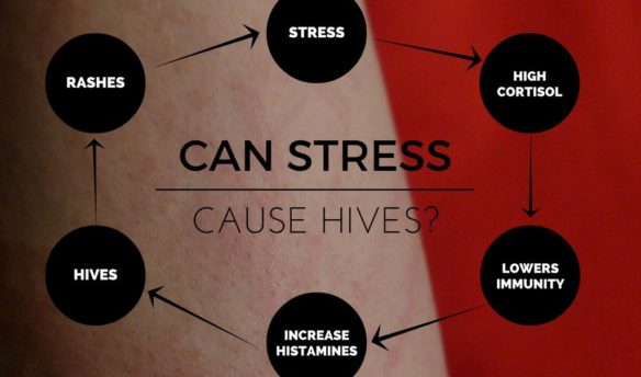 Can Stress Cause Hives