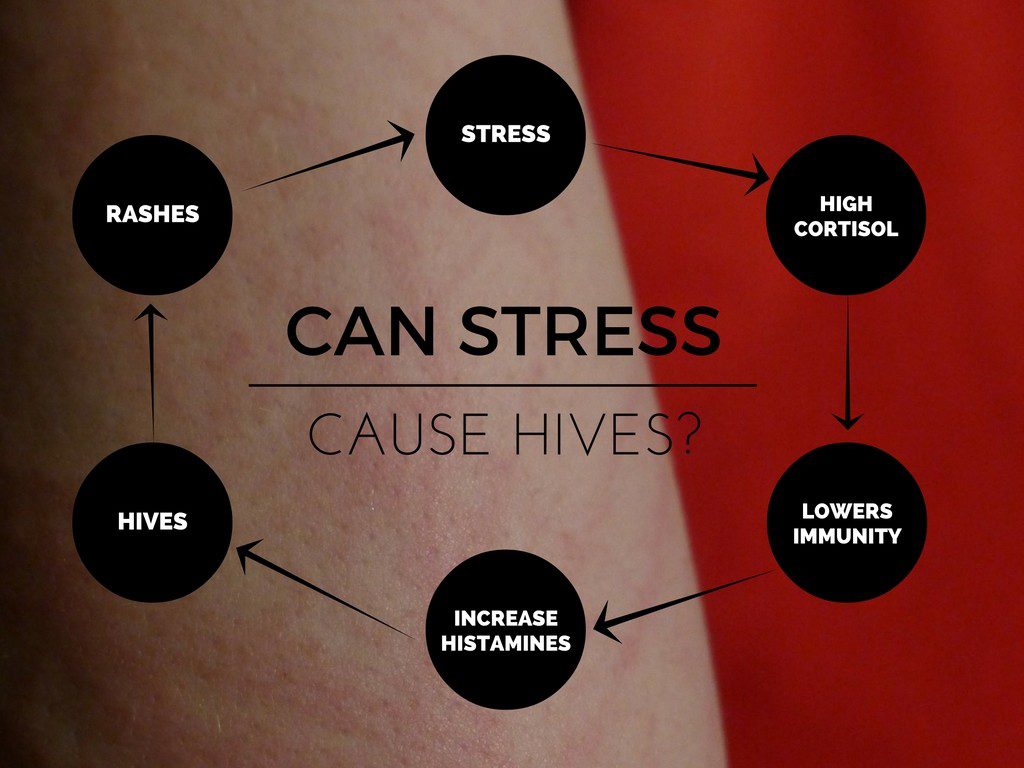 Tips for Managing Stress Hives  rAnxietyhelp